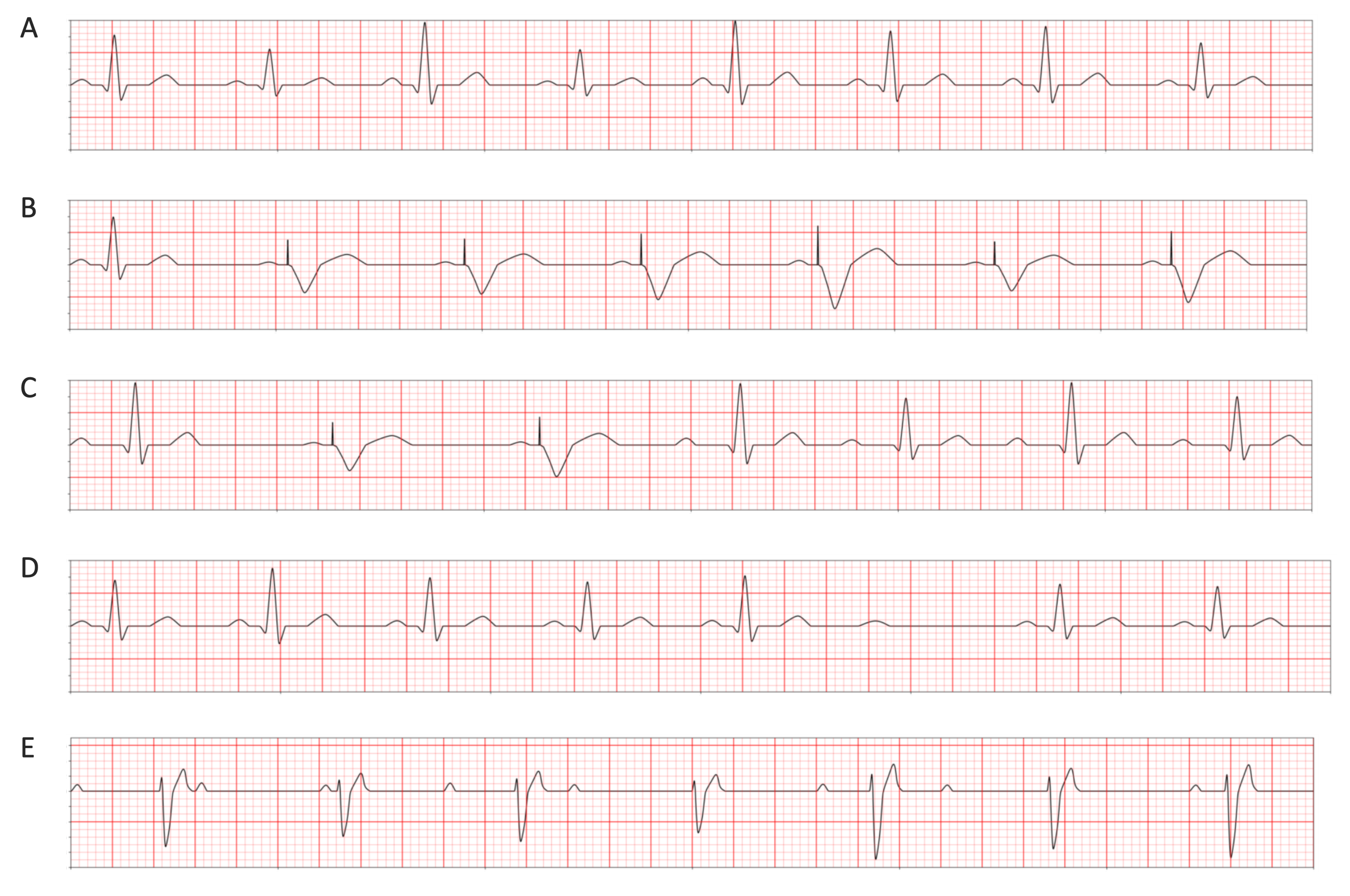 ECG traces for EduPace pathologies and pacing responses